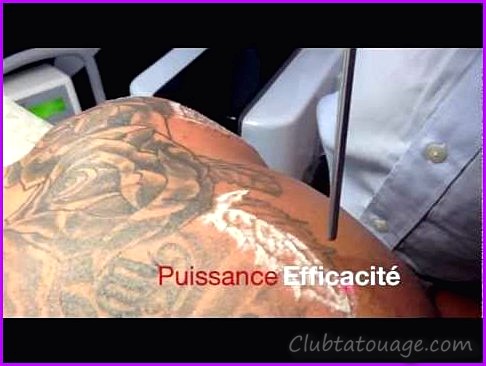 Supprimer les tatouages laser avec le toucher d'un médecin