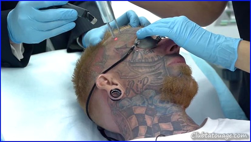 Supprimer les tatouages laser avec le toucher d'un médecin