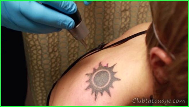 Supprimer le prix du tatouage au laser
