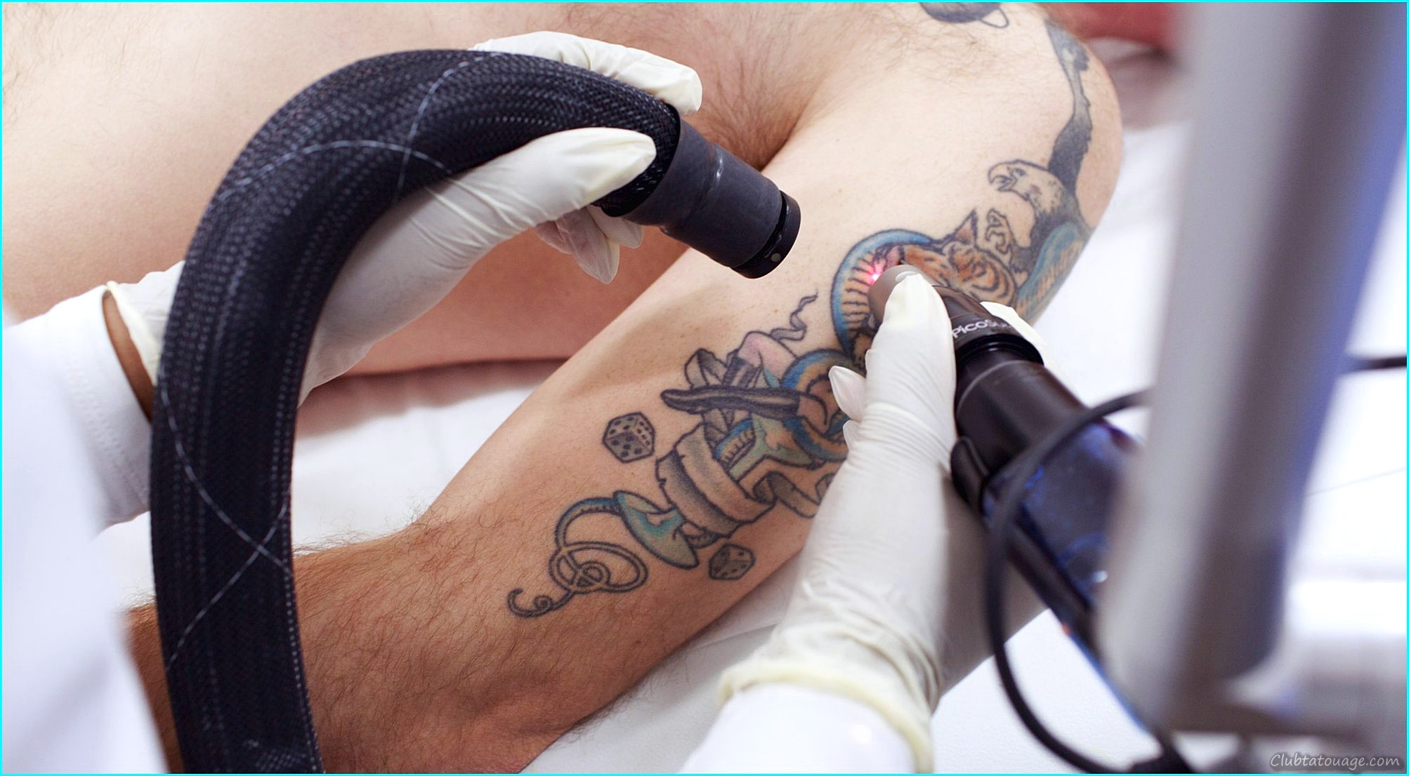 Supprimer le prix du tatouage au laser