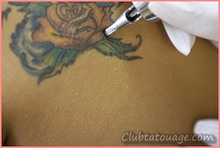 Supprimer les tatouages - Combien cela coûte-t-il de supprimer les tatouages?