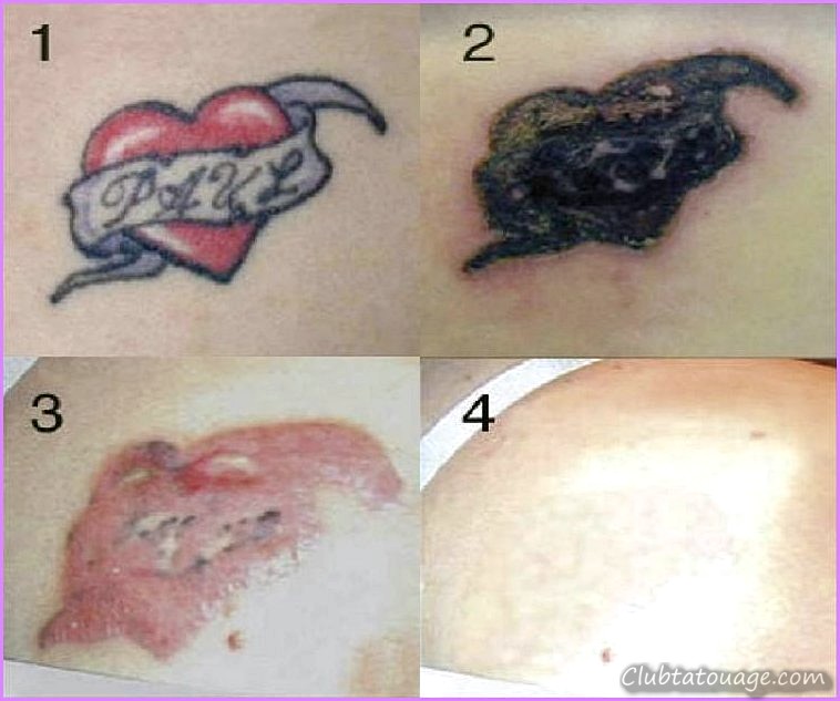 Supprimer les tatouages - Combien cela coûte-t-il de supprimer les tatouages?